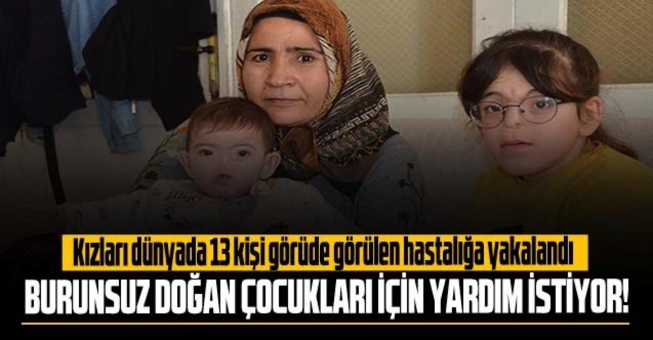 Dünyada sadece 13 kişide görülüyor: Burunsuz doğan çocukları için yardım istiyor