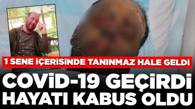 Milyonda 2 görülen hastalığa yakalandı: Yüzü tanınmaz hale geldi