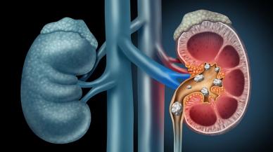 Küresel ısınma böbrek taşı riskini artırıyor