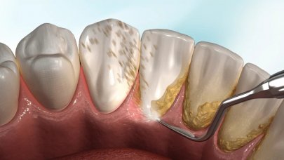 2023 Diş taşı temizliği güncel fiyatları ne kadar, kaç TL'den başlıyor?