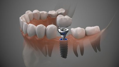 2023 İmplant Güncel Fiyatları, İstanbul'da devlette ve özelde implant kaç bin TL?