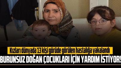 Dünyada sadece 13 kişide görülüyor: Burunsuz doğan çocukları için yardım istiyor