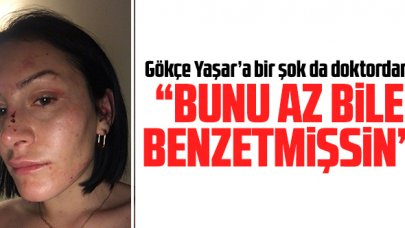 Gökçe Yaşar: Doktor 'Bunu az bile benzetmişsin' dedi!